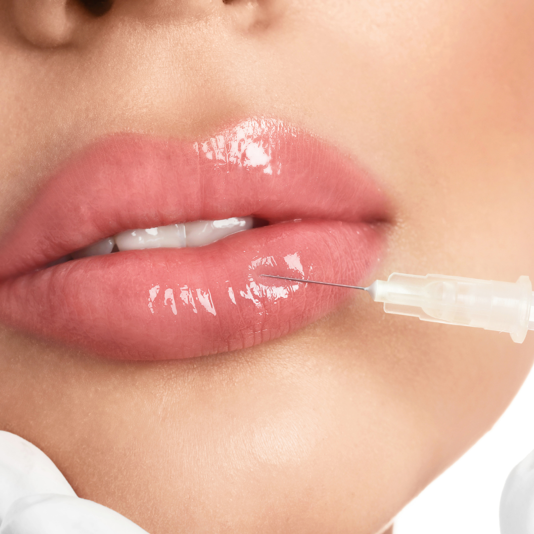 lip filler treatment image Whyte aesthetics