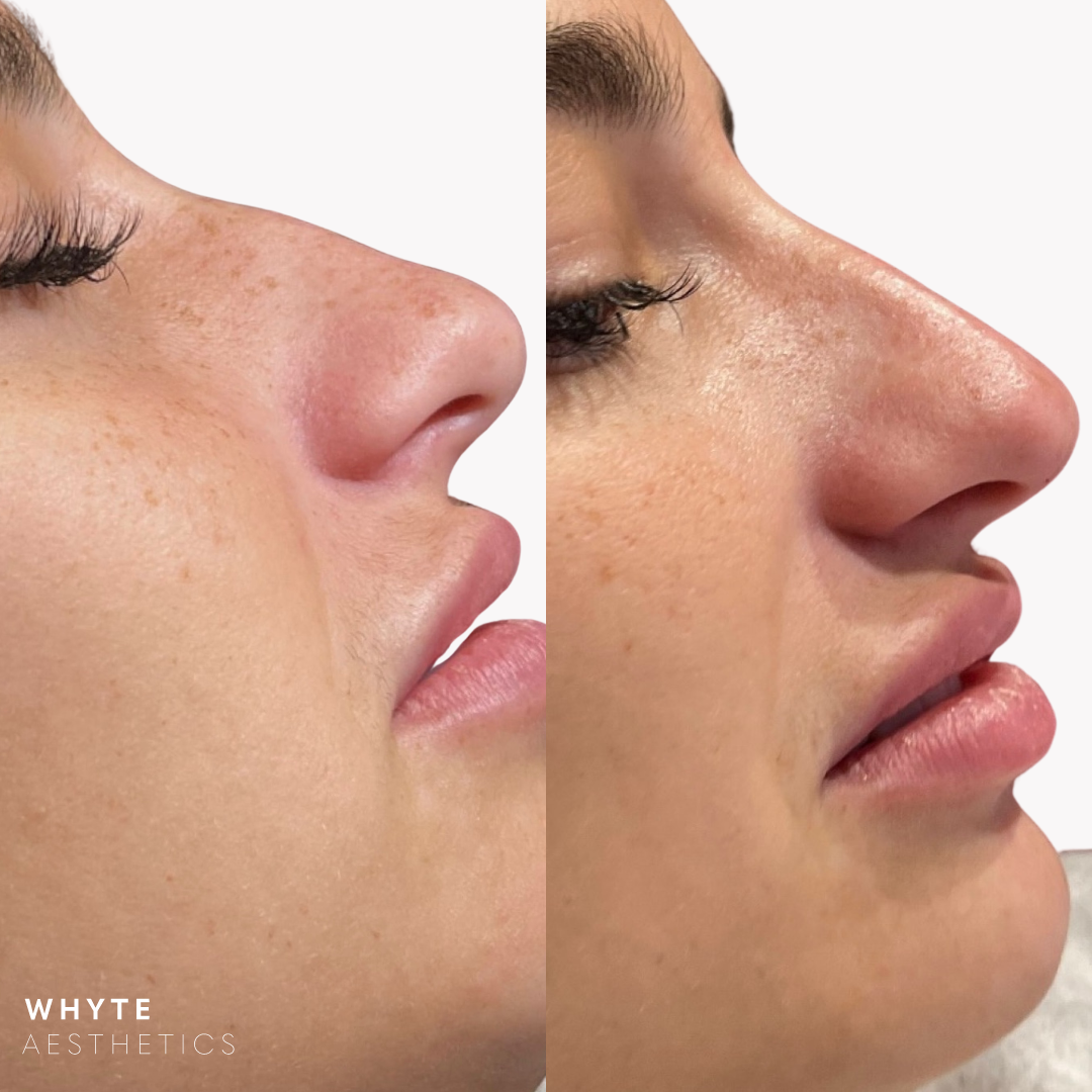 non surgical rhinoplasty before and after image Whyte aesthetics london