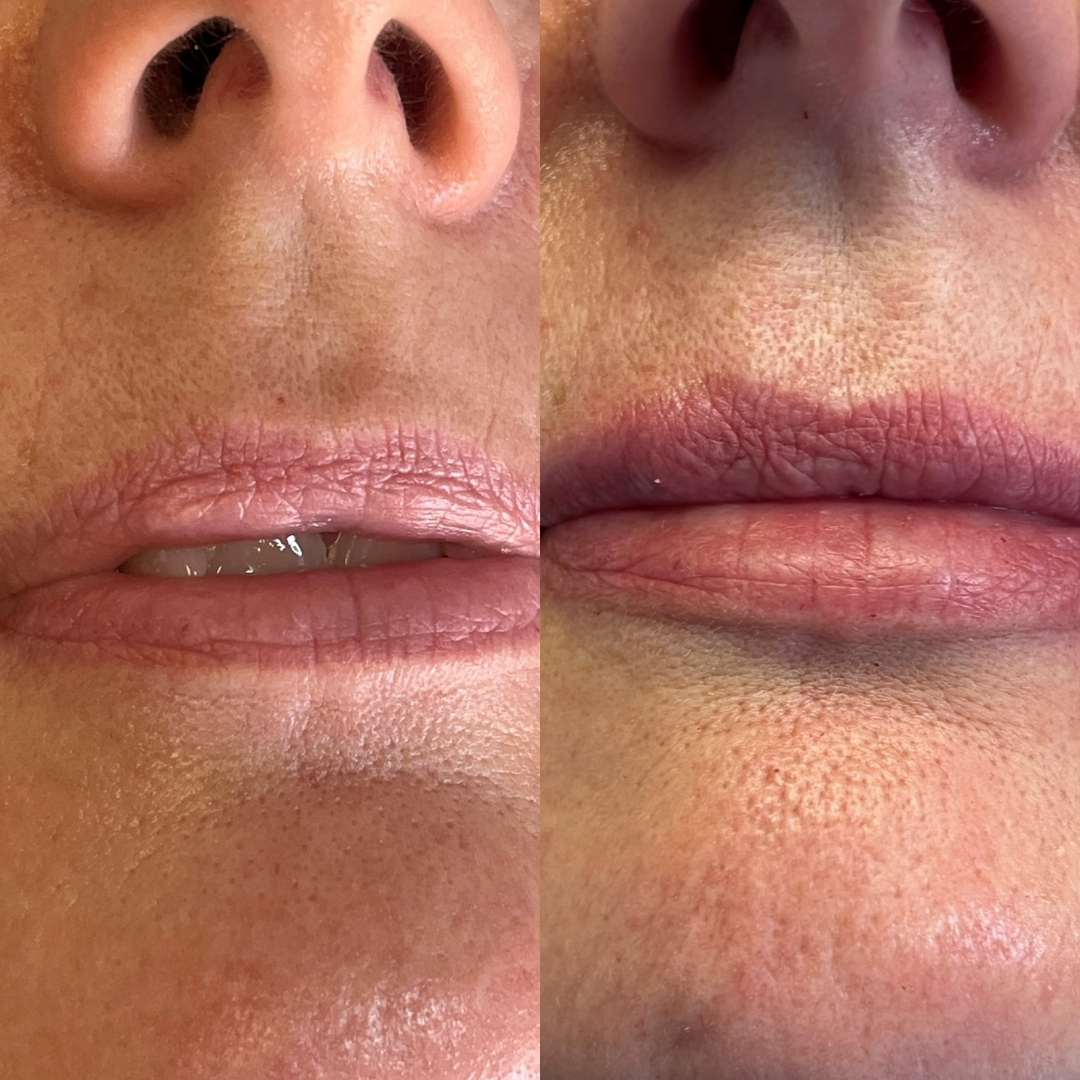 lip filler before and after Whyte aesthetics