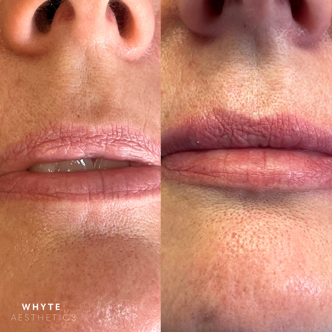 lip filler before and after image Whyte aesthetics