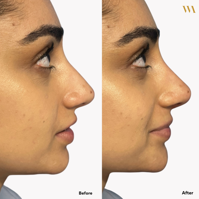 Whyte aesthetics non-surgical rhinoplasty before and after image